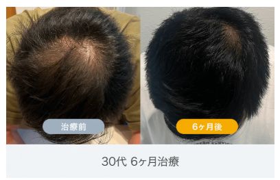 イースト駅前クリニックのAGA治療の症例